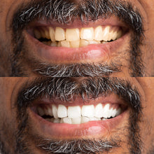 Load image into Gallery viewer, Professional At-Home Teeth Whitening Kit